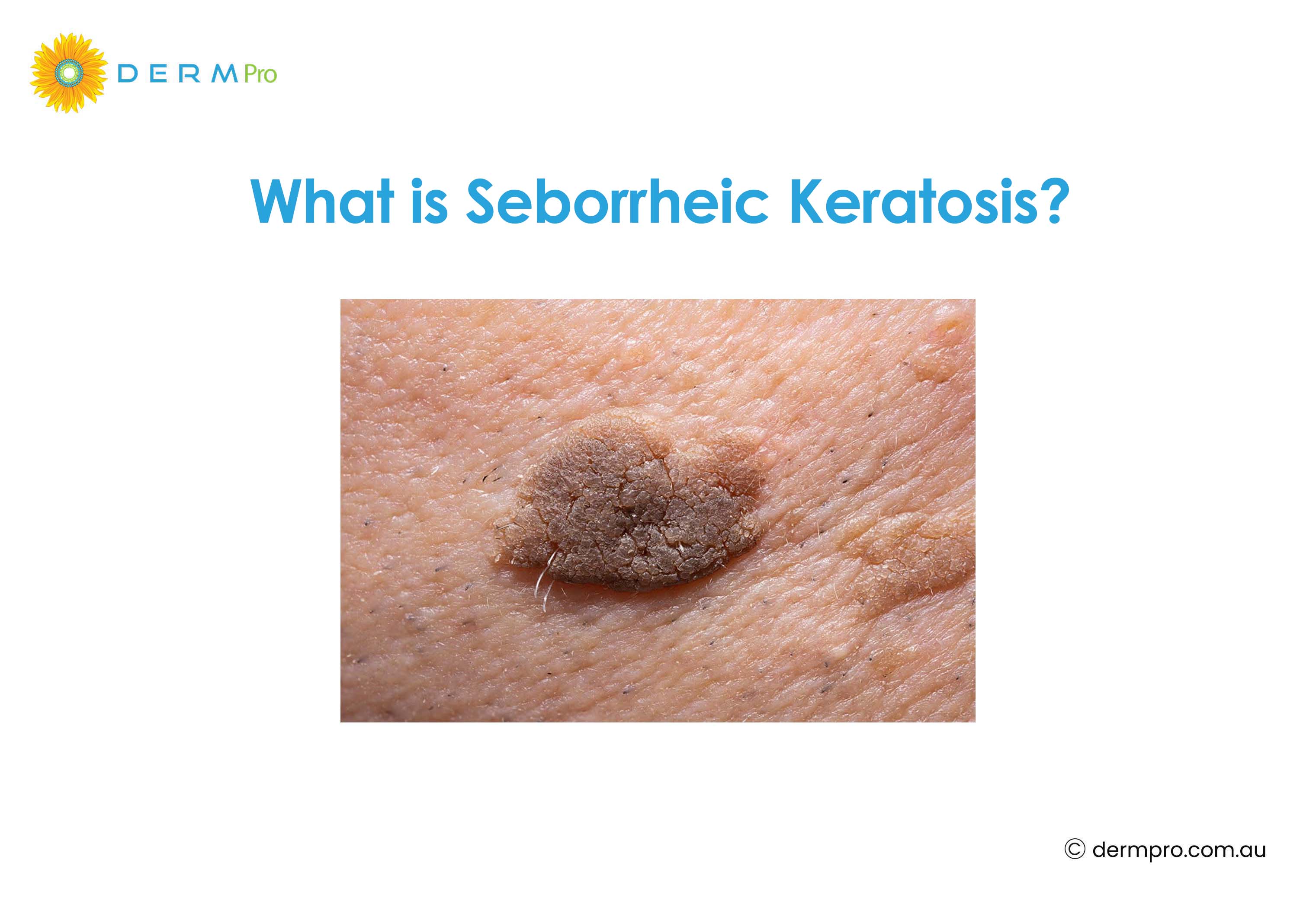 What is Seborrheic Keratosis?